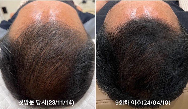 Permanent Makeup in Bellevue | Microblading Kirkland, Eyebrows Bellevue, Lash Lift Bellevue, Bellevue Microblading, Permanent makeup bellevue, male microblading cost, microblading bellevue, Eyebrow microblading for men, microblading men