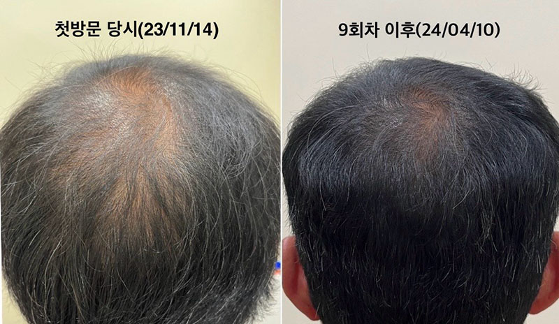 Permanent Makeup in Bellevue | Microblading Kirkland, Eyebrows Bellevue, Lash Lift Bellevue, Bellevue Microblading, Permanent makeup bellevue, male microblading cost, microblading bellevue, Eyebrow microblading for men, microblading men