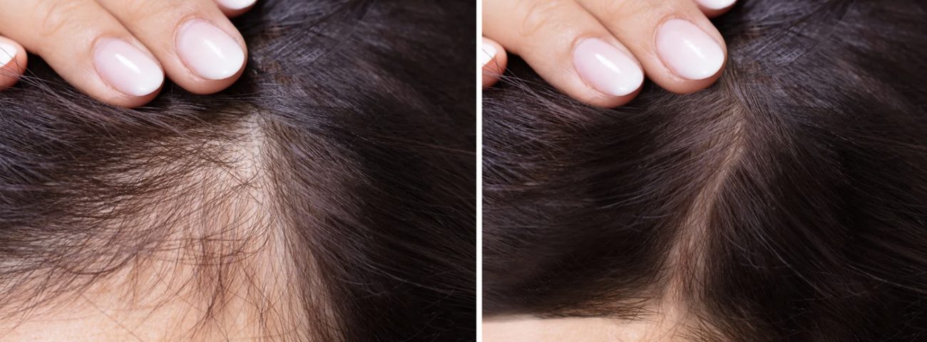 Hair Loss No More! Stop stressing and call us now!