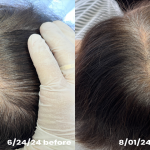 Stem cell hair loss treatment