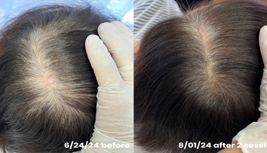 Stem cell hair loss treatment