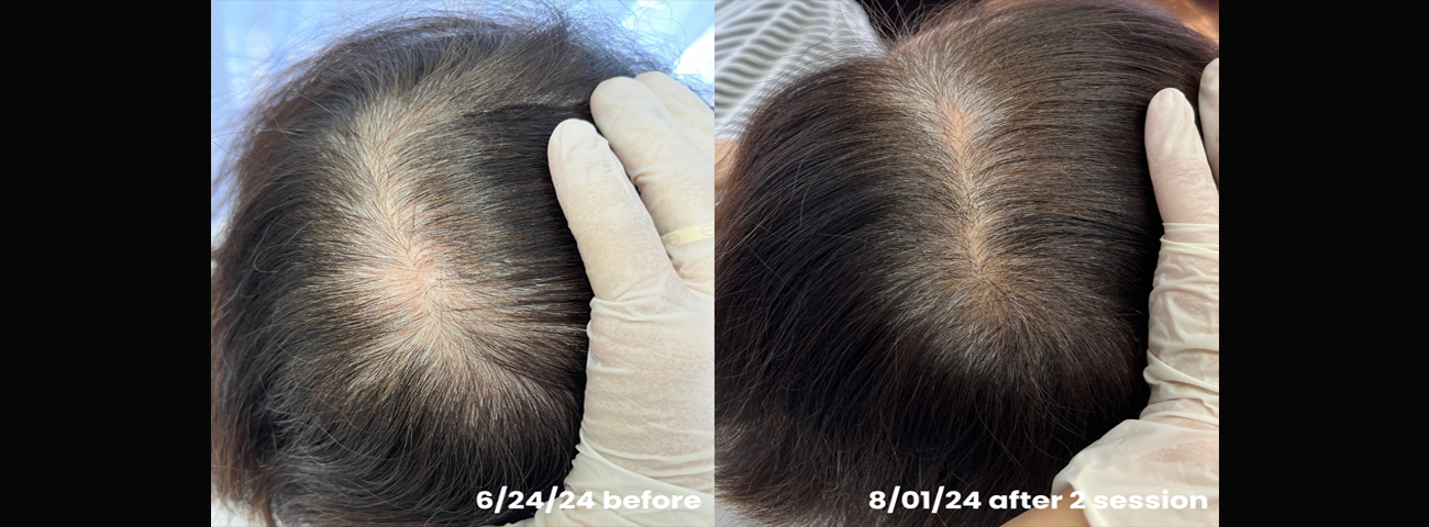 Stem cell hair loss treatment